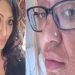 ടിക്ടോക്കിൽ വൈറലായ പാചകക്കുറിപ്പ് പരീക്ഷിച്ചു, മുട്ട പൊട്ടിത്തെറിച്ച് യുവതിക്ക് പൊള്ളൽ