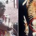 56 വർഷം വയറ്റില് ചുമന്നത് ‘സ്റ്റോണ് ബേബി’യെ; സർജറിക്ക് പിന്നാലെ 81 -കാരിക്ക് ദാരുണാന്ത്യം