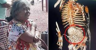 56 വർഷം വയറ്റില് ചുമന്നത് ‘സ്റ്റോണ് ബേബി’യെ; സർജറിക്ക് പിന്നാലെ 81 -കാരിക്ക് ദാരുണാന്ത്യം
