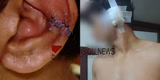 ജൂനിയര് വിദ്യാര്ഥികളുടെ ആക്രമണം; ചെവി മുറിഞ്ഞുപോയ വിദ്യാർത്ഥിക്ക് അധ്യാപകര് ചികിത്സ വൈകിപ്പിച്ചെന്ന് പരാതി