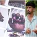കൊഴുപ്പ് നീക്കൽ ശസ്ത്രക്രിയയിലെ പിഴവ്: സിറ്റി പൊലീസ് കമ്മീഷണർ അന്വേഷിക്കണമെന്ന് മനുഷ്യാവകാശ കമ്മീഷൻ ഉത്തരവ്