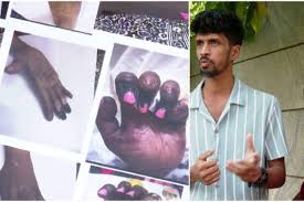 കൊഴുപ്പ് നീക്കൽ ശസ്ത്രക്രിയയിലെ പിഴവ്: സിറ്റി പൊലീസ് കമ്മീഷണർ അന്വേഷിക്കണമെന്ന് മനുഷ്യാവകാശ കമ്മീഷൻ ഉത്തരവ്